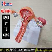 Mô Hình Các Bệnh Lý Ở Tử Cung