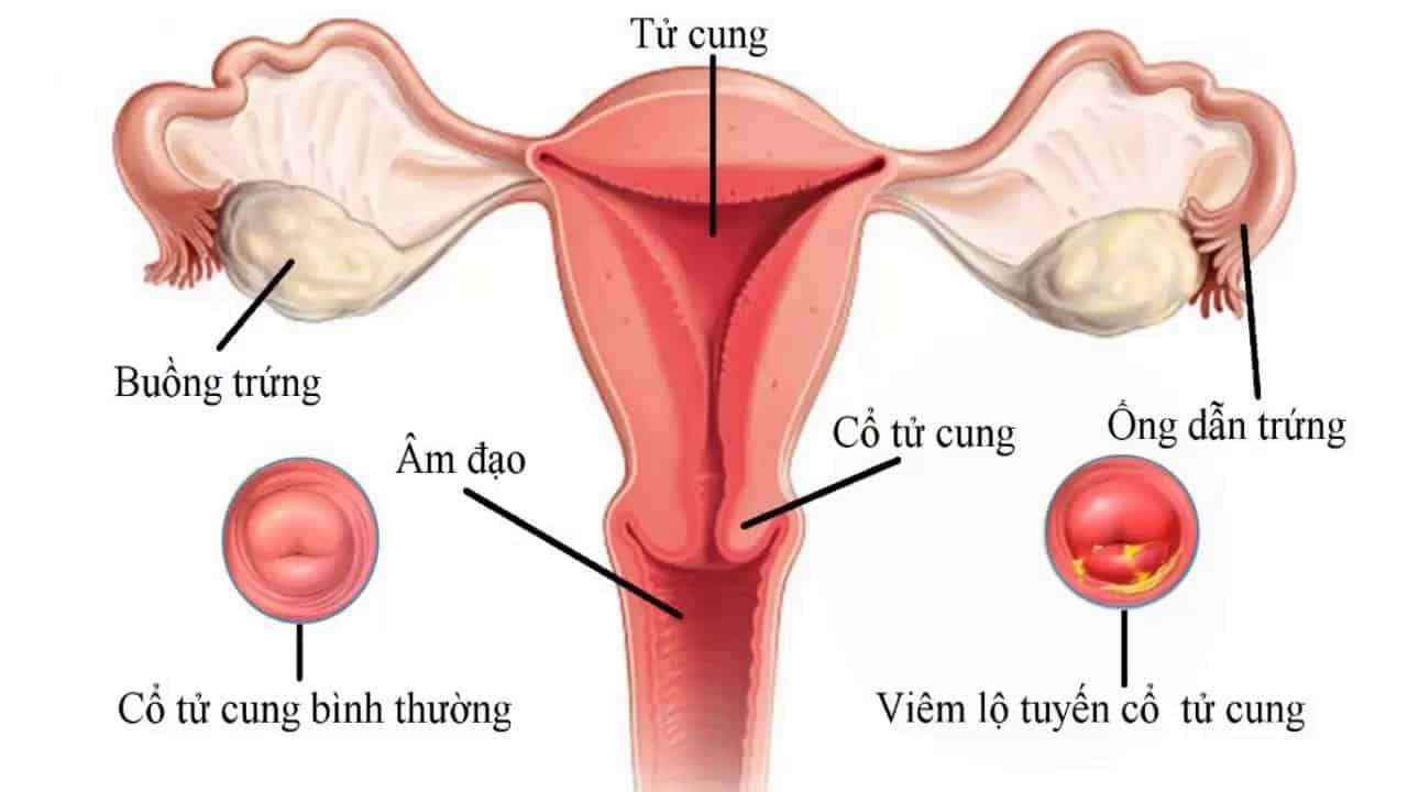 máy áp lạnh cổ tử cung