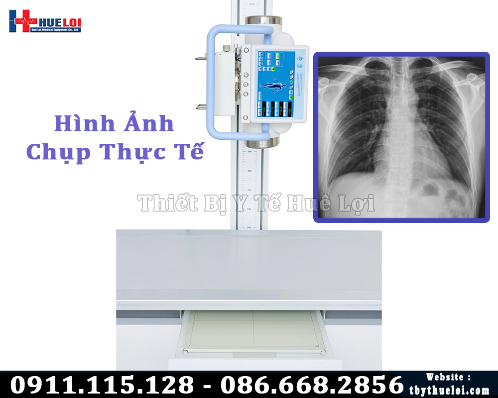 Hình ảnh chụp X Quang Bằng máy Yolong