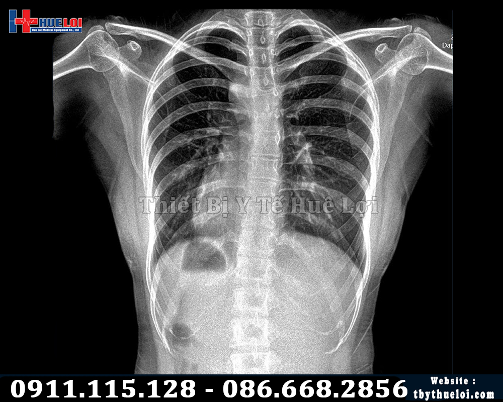 X Quang YOLONG chụp giá rẻ