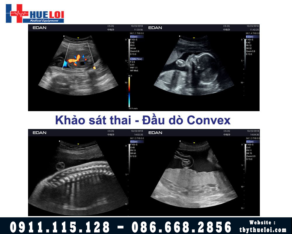 Hình ảnh thai đầu dò convex AX3