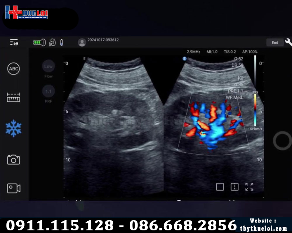 hình ảnh siêu âm từ máy siêu âm cầm tay c5