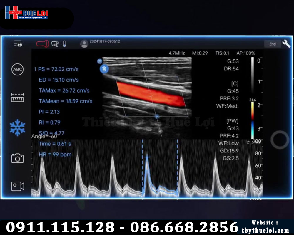 hình ảnh kết quả siêu âm từ máy siêu âm EDAN c5