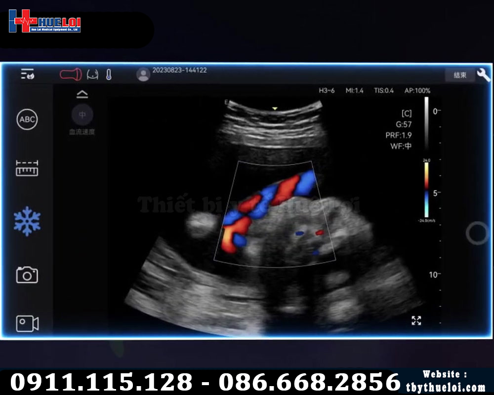 kết quả siêu âm máy edan