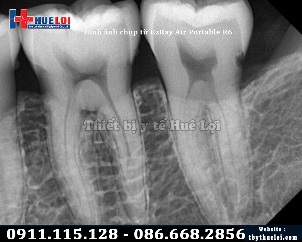 Hình ảnh máy chụp X Quang răng cầm tay Vatech