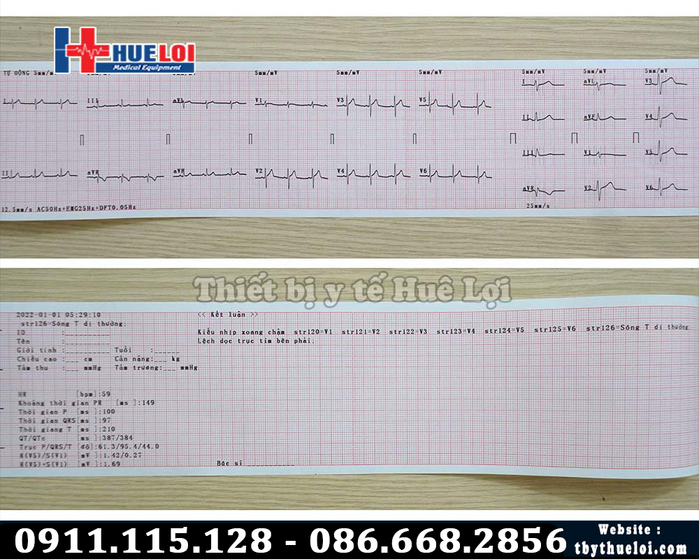kết quả điện tim bằng máy Contec 300G